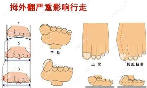 拇外翻后遺癥有哪些