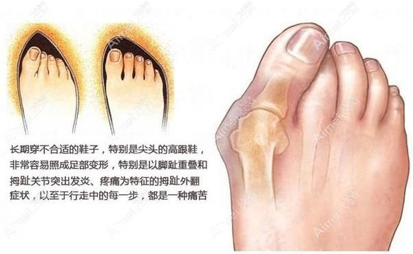 微創(chuàng)拇外翻手術(shù)多少錢 aimei.com