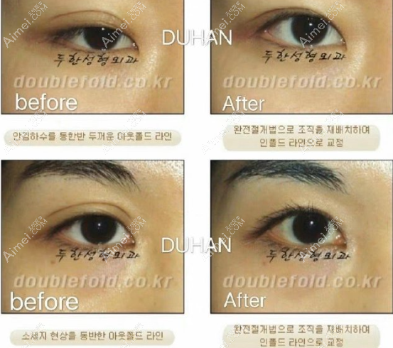 韩国枓翰医院双眼皮修复前后对比图片