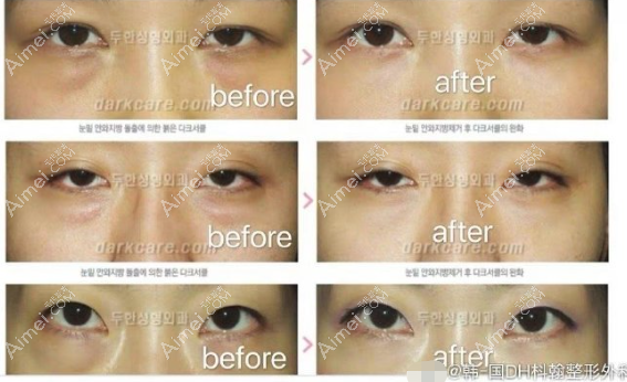 韩国枓翰医院眼袋修复前后对比照片