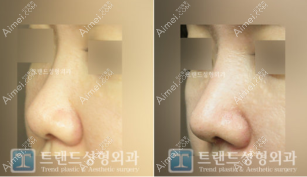 韩国trend医院女生蒜头鼻隆鼻前后对比照片