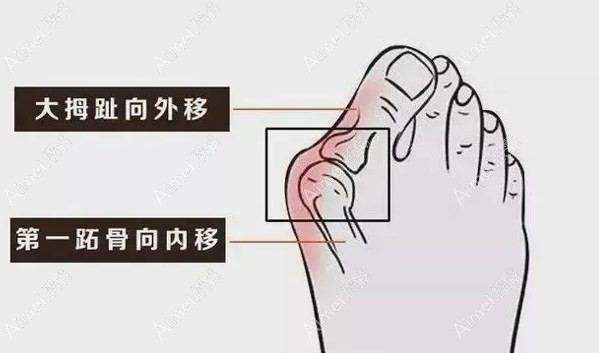 沈阳北方医院做大脚骨微创手术优势m.aimei.com