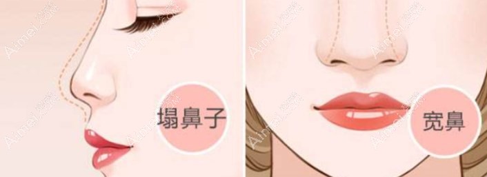 刘凯鼻修复手术后的真实示例
