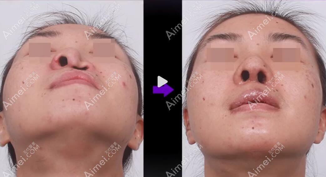 韩国noselips崔寓植嘴唇+人中+鼻畸形修复对比图