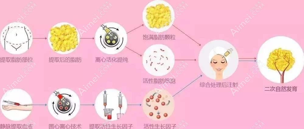 冯斌是国内较早开展脂肪填充的医生