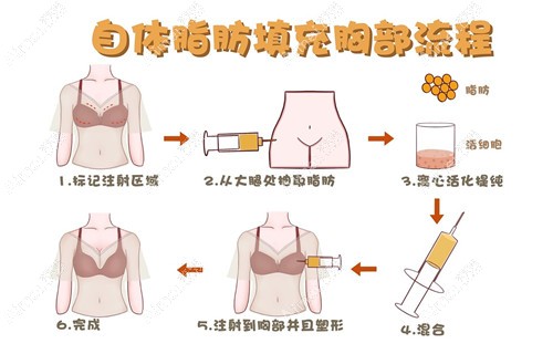 孙泽芳是北京自体脂肪丰胸技术好的医生