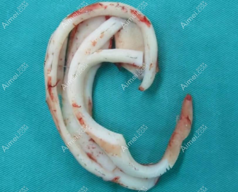 余文林耳再造雕刻模型