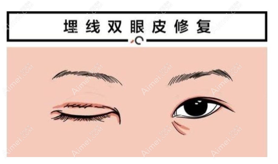 魏志香双眼皮修复技术好