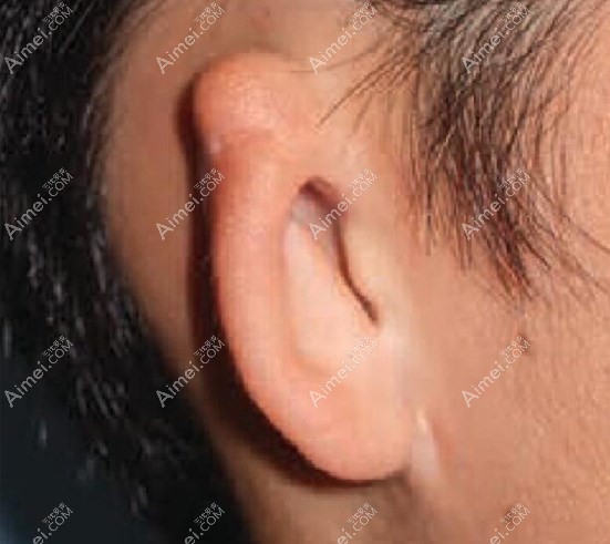 耳畸形一二三度的图片,不同程度耳再造费用/修复年龄有差距