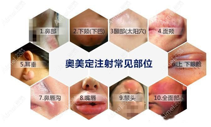 广州奥美定取出排名前三医院推荐 广州奥美定取出排名前三医院推荐