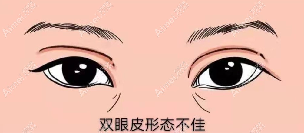 张冰洁眼修复实例