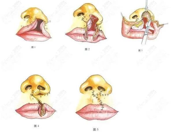 成人唇裂二期修复手术全过程图解www.aimei.com