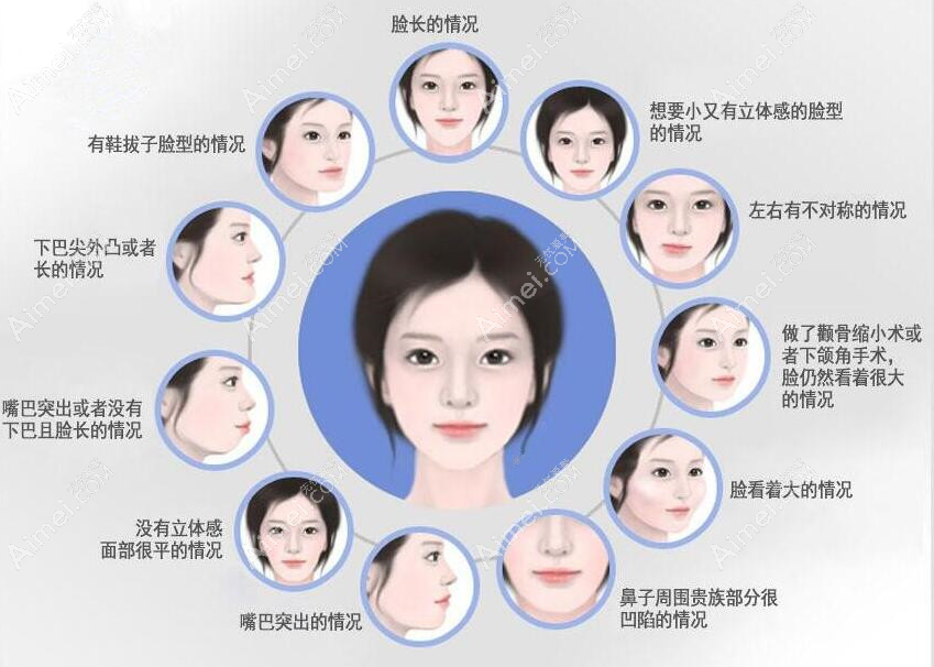 韩国全脸磨骨手术部位