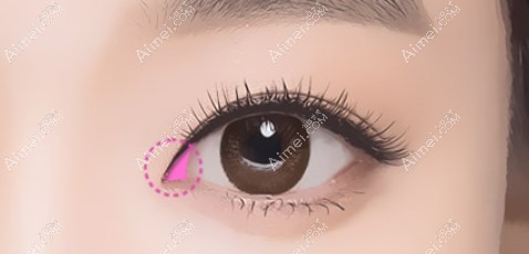 张冰洁眼角修复实例