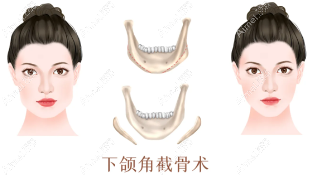 广州磨骨改脸型排名前三医美 广州磨骨改脸型排名前三医美