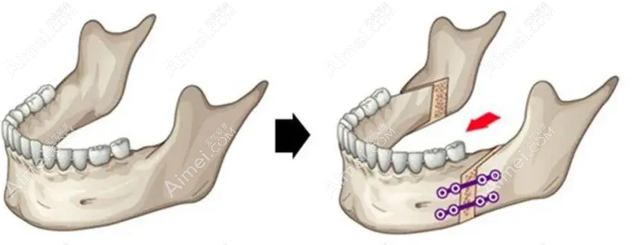 广大医院正颌手术好的医生是何锦泉和艾伟健