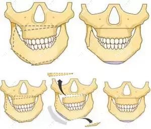 广州广大医院做正颌技术好