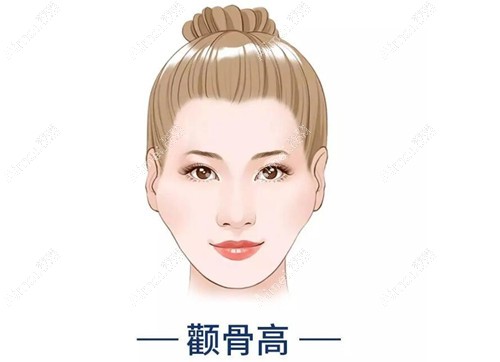 北京张笑天做颧骨手术价格6w+不贵,颧骨内推成效好脸型自然