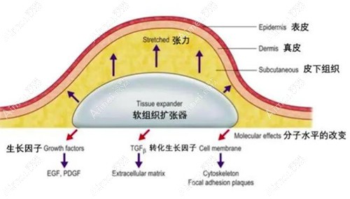 扩张器