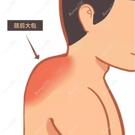 土麦森去富贵包手术技术图