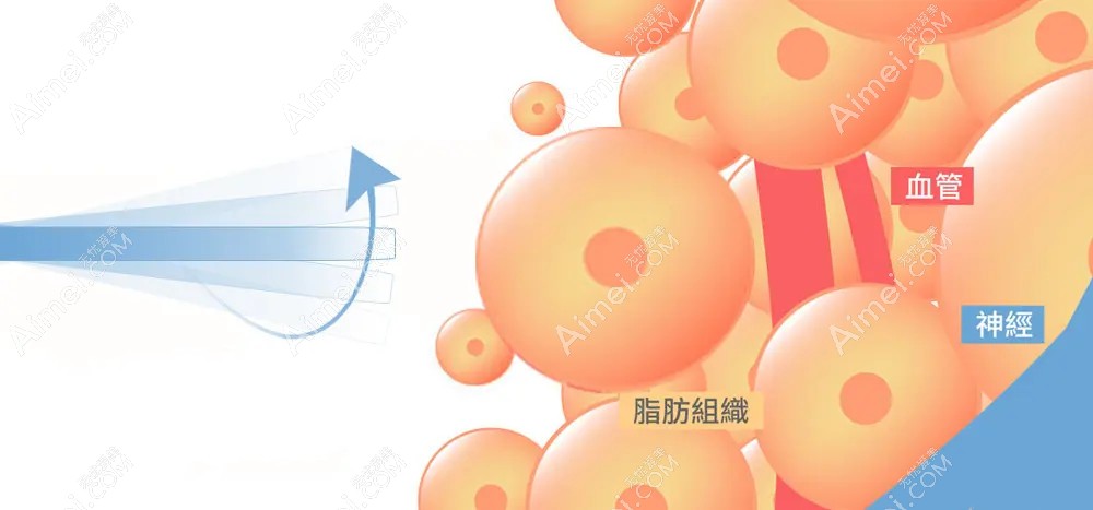 土麦森吸脂技术可靠