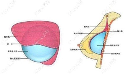 长沙假体隆胸好的医院医生排名
