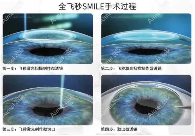全飞秒手术过程