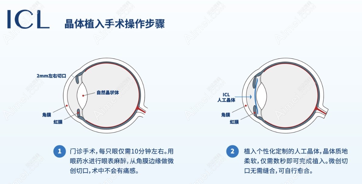 晶体植入近视手术费用:北京|广州|重庆icl晶体植入26000元起