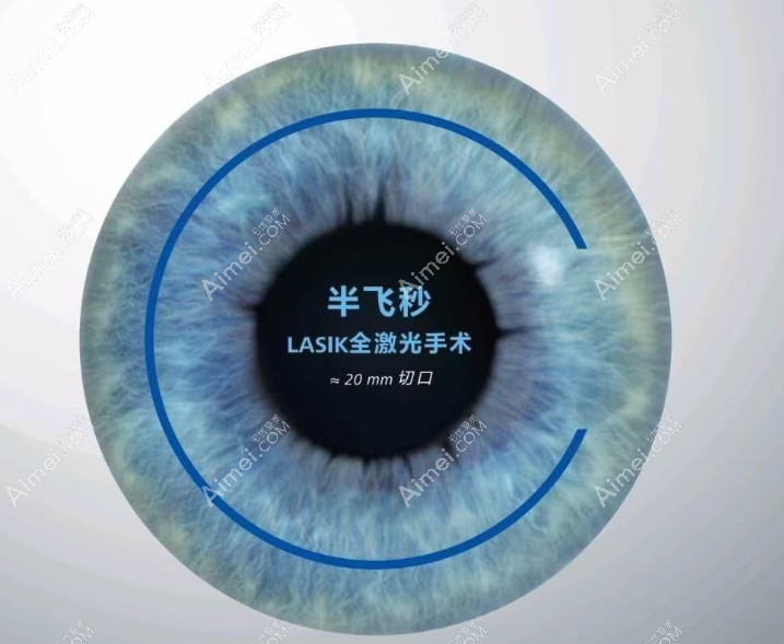 近视眼700度手术半飞秒价格11000元起