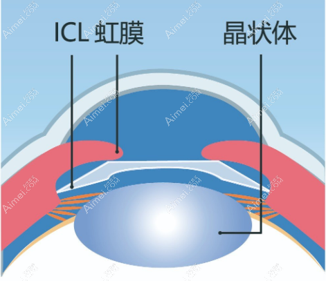 重庆icl晶体手术