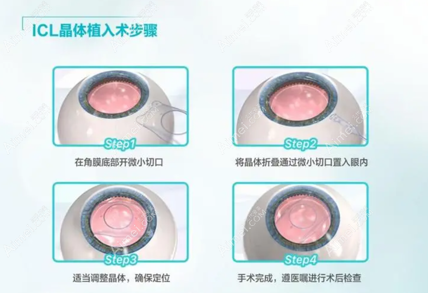 icl晶体植入近视眼手术过程和步骤