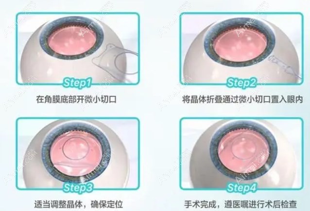 西安近视眼晶体植入手术好的医院