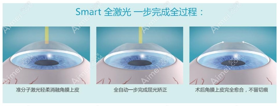 smart全激光手术的优缺点
