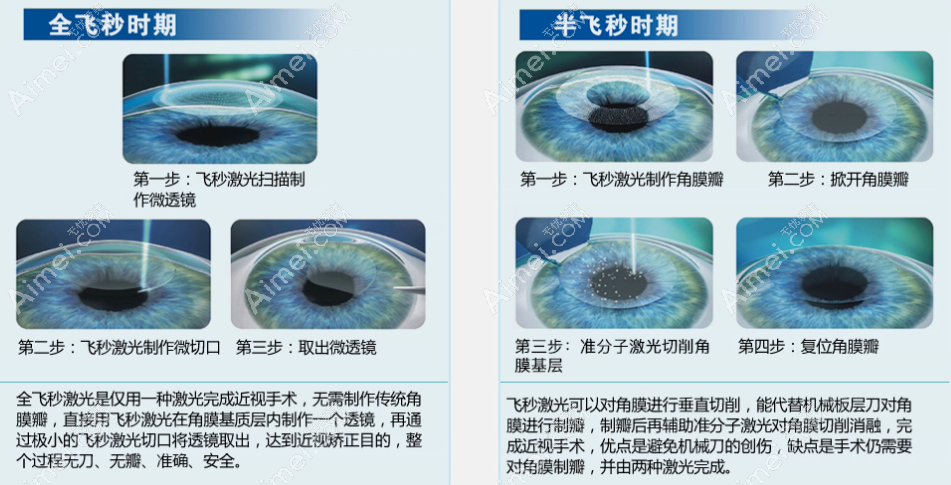 全飛秒和半飛秒手術(shù)方式對比