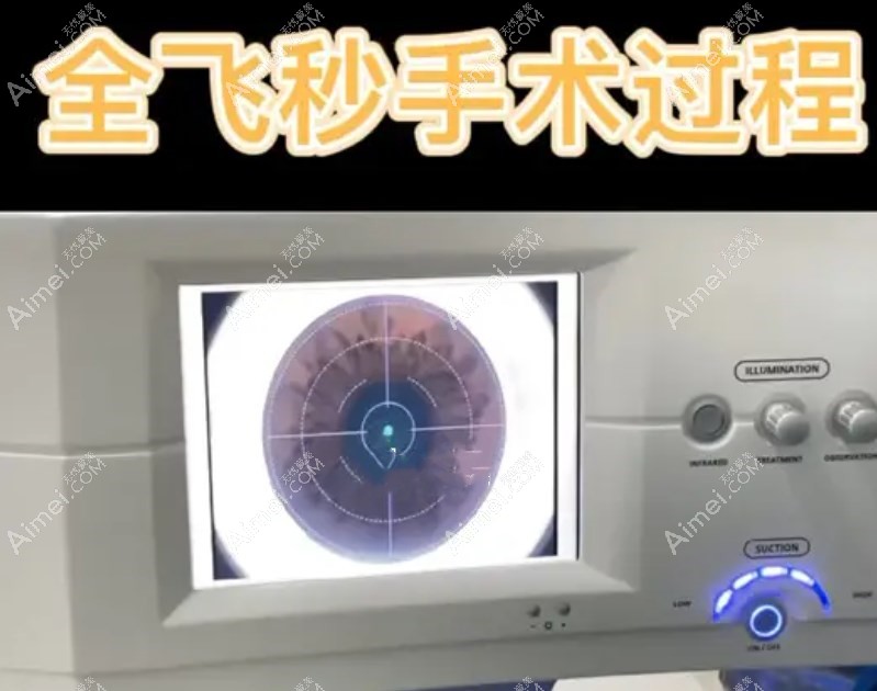 全飞秒近视手术能管一辈子是真的,费用才18000起不贵值得做
