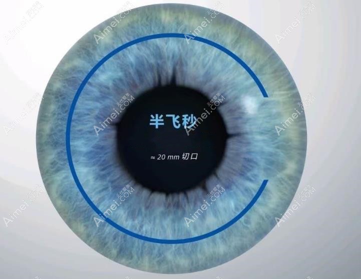 半飞秒手术优点和缺点解析