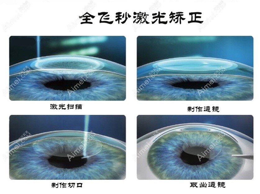 昆明眼科医院全飞秒激光近视眼手术