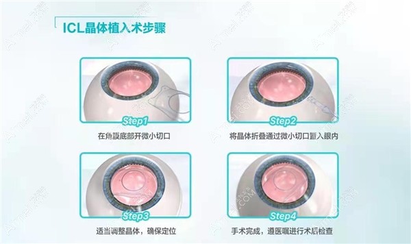 昆明眼科医院ICL人工晶体植入手术