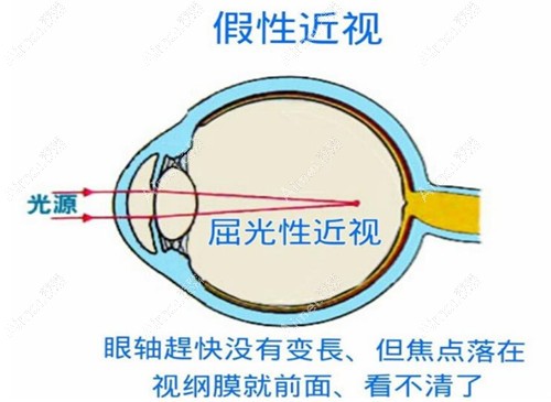 判断屈光性近视是不是假性近视的10个征兆:眼疲劳/眩晕/斜视