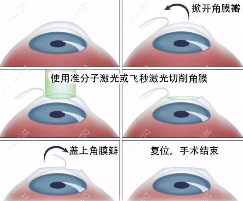 成人激光近视手术费用8800元起