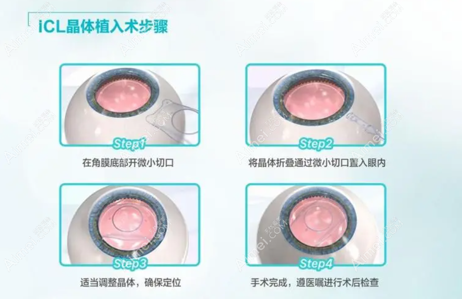 晶体置换跟晶体植入区别