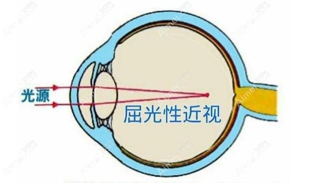 屈光性近视