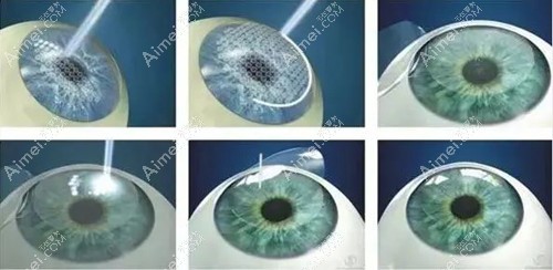 半飞秒激光手术3d演示全过程视频:术后角膜瓣3个月左右愈合