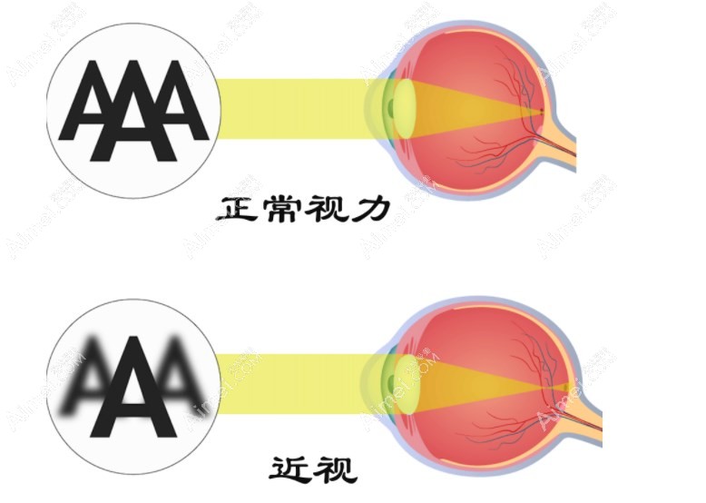 重庆高度近视手术好的眼科医院推荐重庆佰视佳眼科