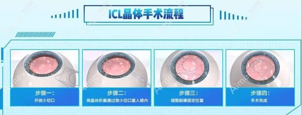 icl晶体植入流程