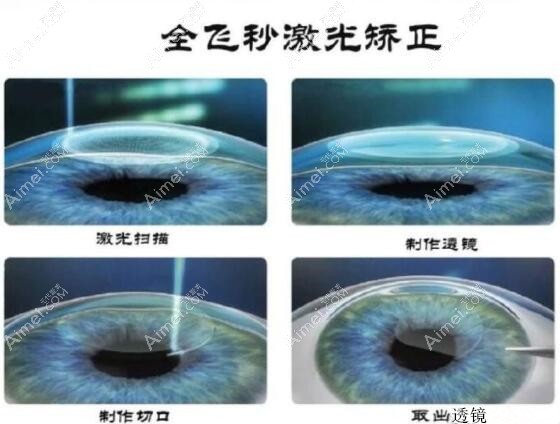 全飞秒近视眼手术治疗过程m.aimei.com 全飞秒近视眼手术治疗过程m.aimei.com