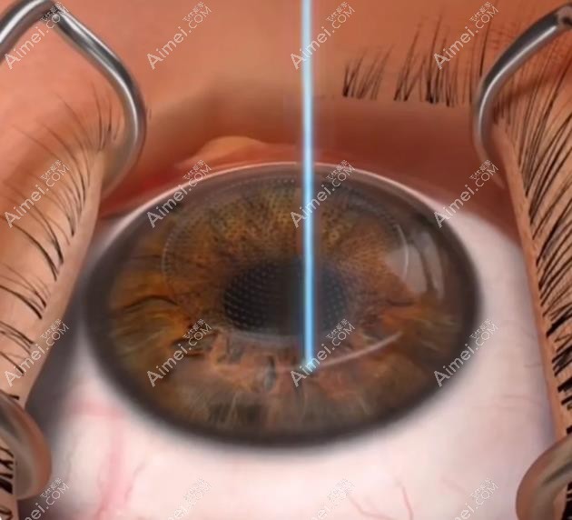 全飞秒后视力回退怎么办 全飞秒后视力回退怎么办