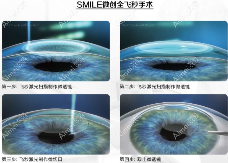长沙半飞秒手术大概要13000元起 长沙半飞秒手术大概要13000元起