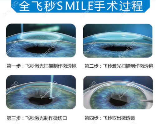 长沙全飞秒手术价格15000元起aimei.com 长沙全飞秒手术价格15000元起aimei.com