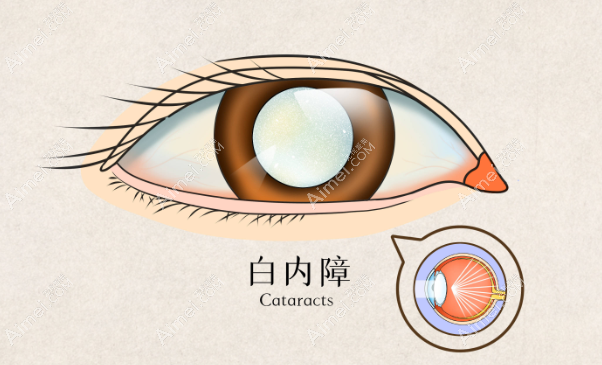 长沙博视眼科医院白内障手术价格